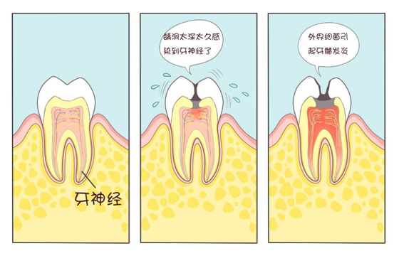 爱牙月科普 | 牙齿剧烈疼痛需要及时治疗(图1)